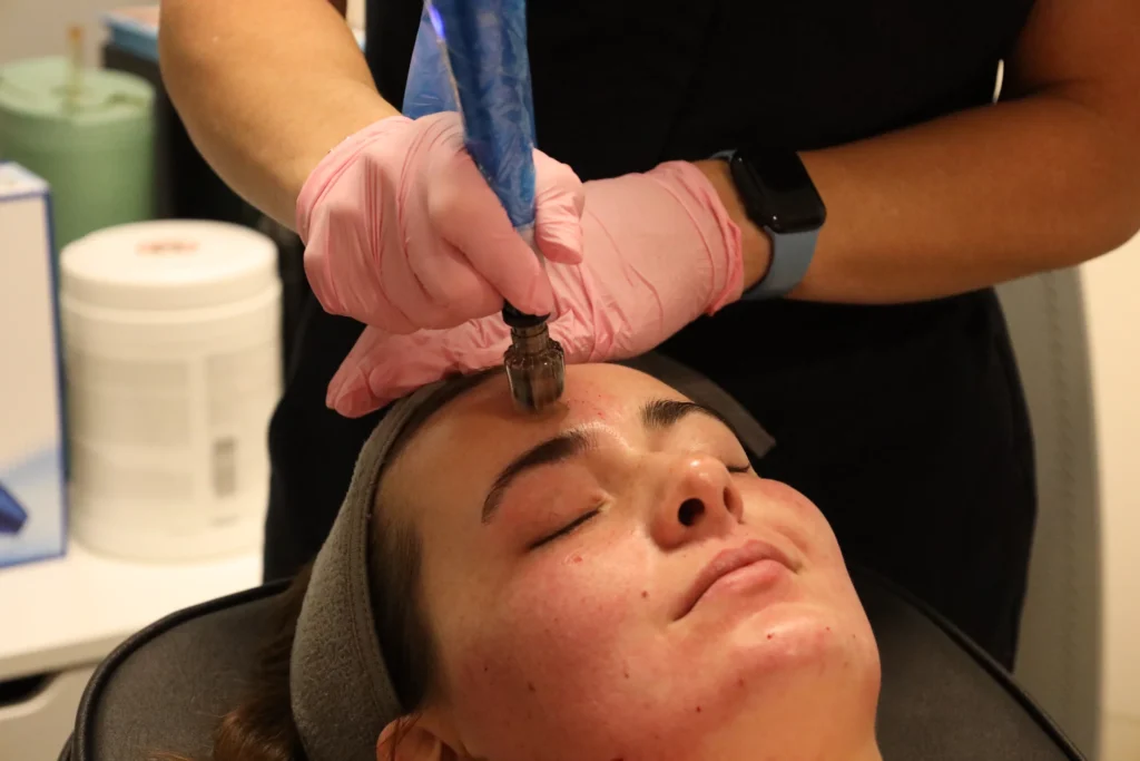 collagen induction therapy