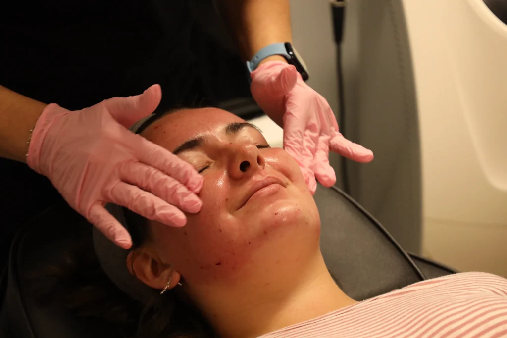 collagen induction therapy