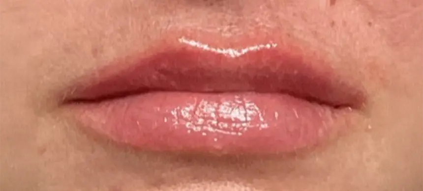 Solace Lip Filler After