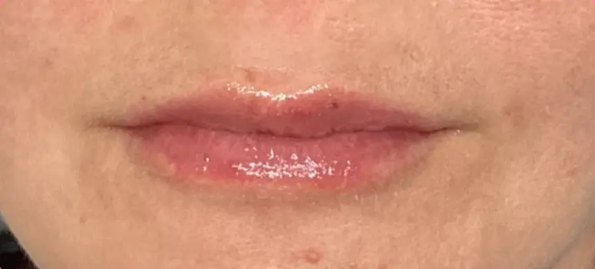 Lip Filler After