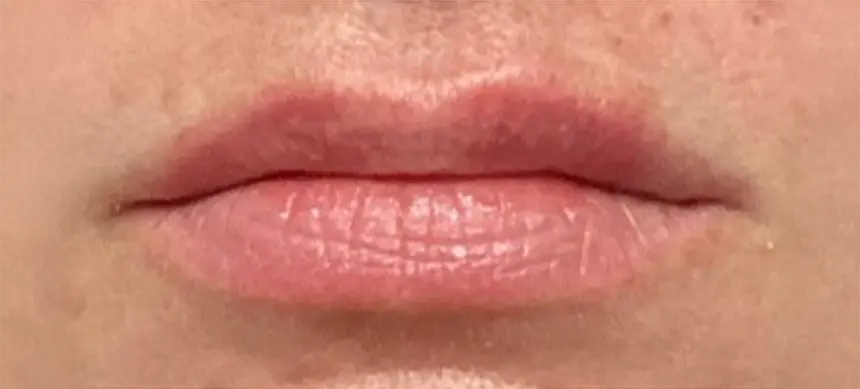 Solace Lip Filler Before