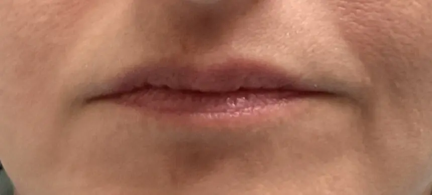 Lip Filler Before