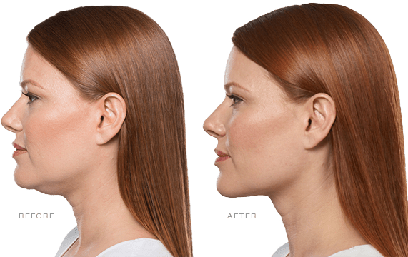 Kybella injections