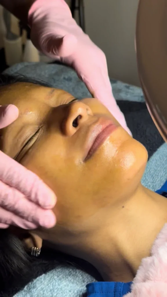 chemical peel treatment